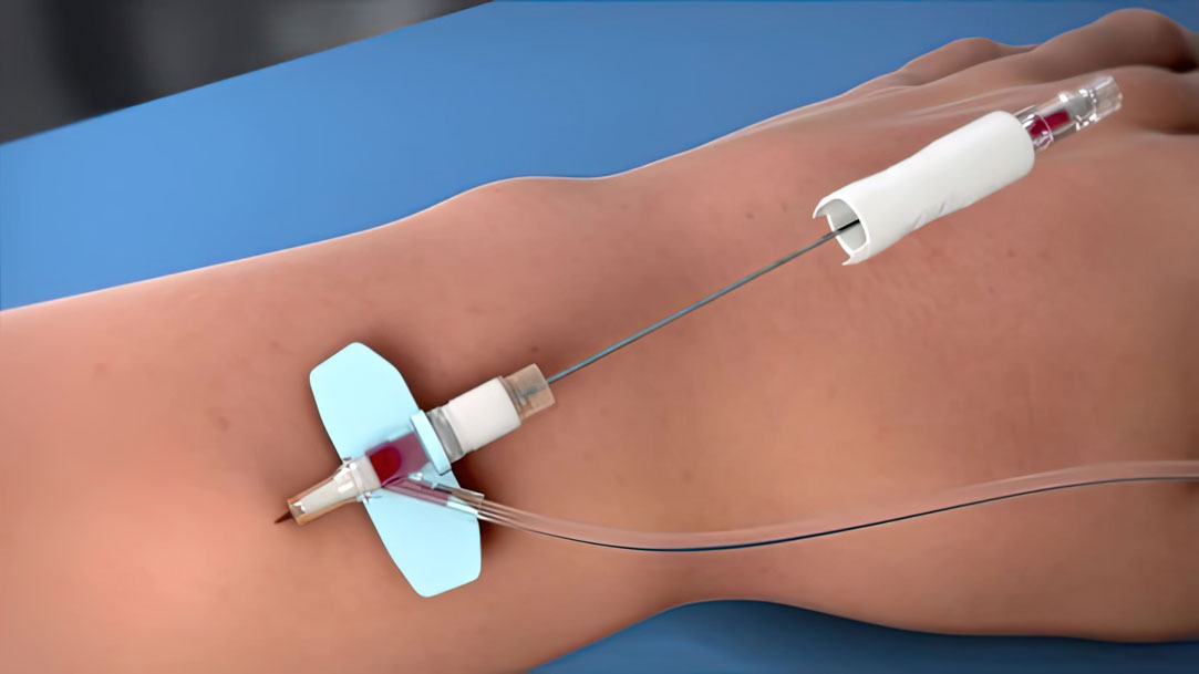 The DeltaVen Hemodialysis system is shown in this medical illustration. It is an advanced medical treatment for patients with kidney failure. Hemodialysis removes waste and excess fluid from the blood. The DeltaVen system is designed for hemodialysis, allowing healthcare providers to administer necessary fluids and medications while also providing access to the patient's bloodstream. DeltaVen is a vital tool in the fight against kidney failure.