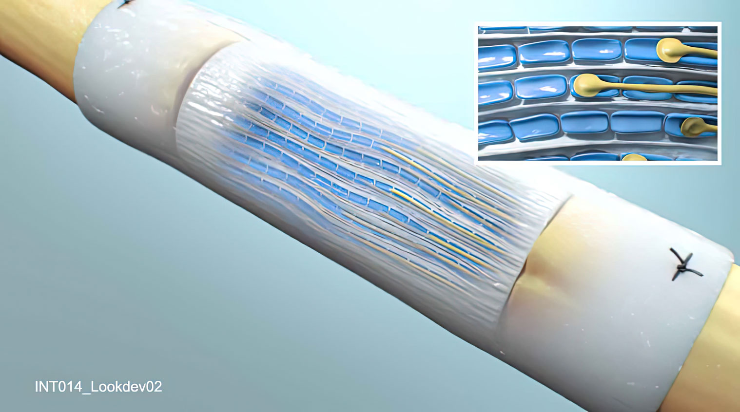 Animation showing the NeuraGen Nerve Guide, a resorbable implant for repairing peripheral nerve discontinuities. It creates a protective environment for nerve repair, acting as a conduit for axonal growth across a nerve gap. Produced for Integra Life Sciences.
