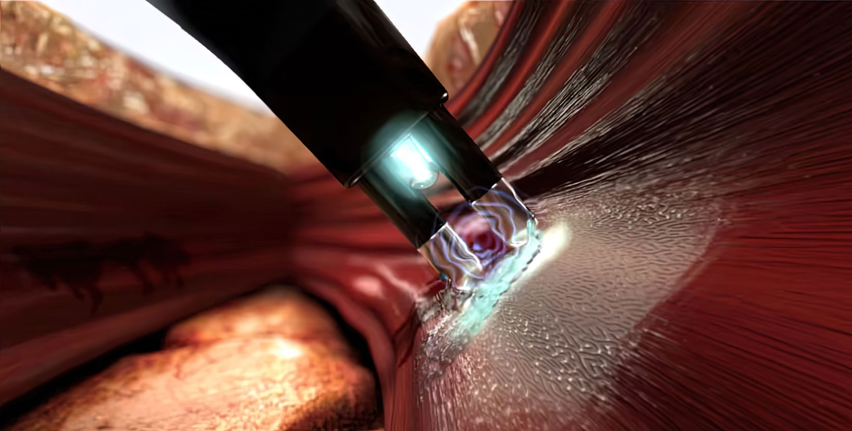 Illustration of the Salient Surgical Aquamantys System, a medical device that uses radiofrequency energy and saline to seal soft tissue and bone. Animation shows the device in action, reducing bleeding and tissue damage during surgery. Revolutionary technology by Ghost Productions.