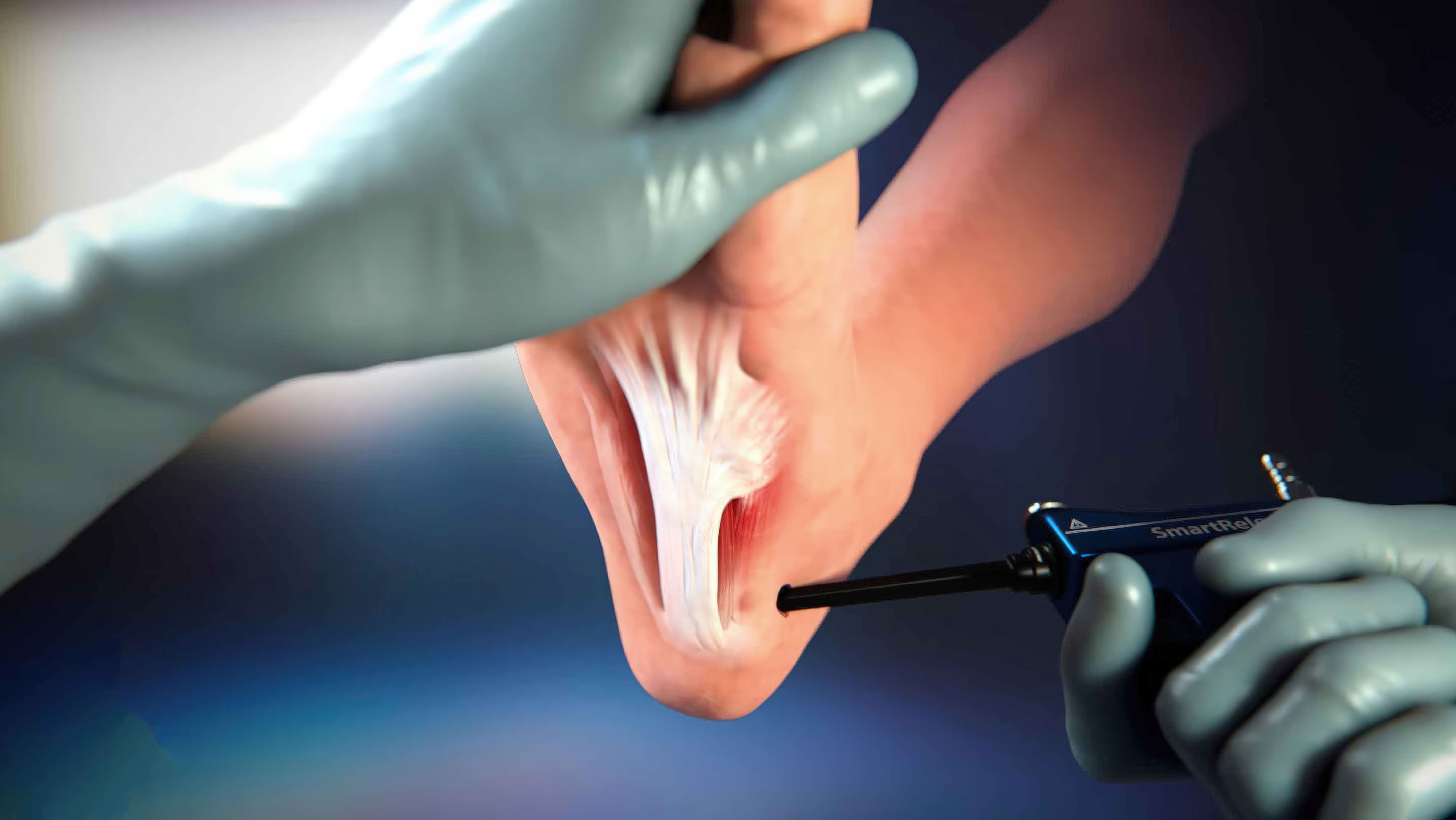 The MicroAire SmartRelease System is a solution for foot pain relief. It involves cutting part of the plantar fascia ligament to relieve tension and inflammation. The system comprises an endoscope and a handpiece that holds an elongated, disposable blade assembly, which connects to any standard video camera and light source. The surgeon introduces the blade assembly into the carpal tunnel through a limited incision in the wrist flexor crease, providing a minimally invasive and effective solution for foot pain relief.