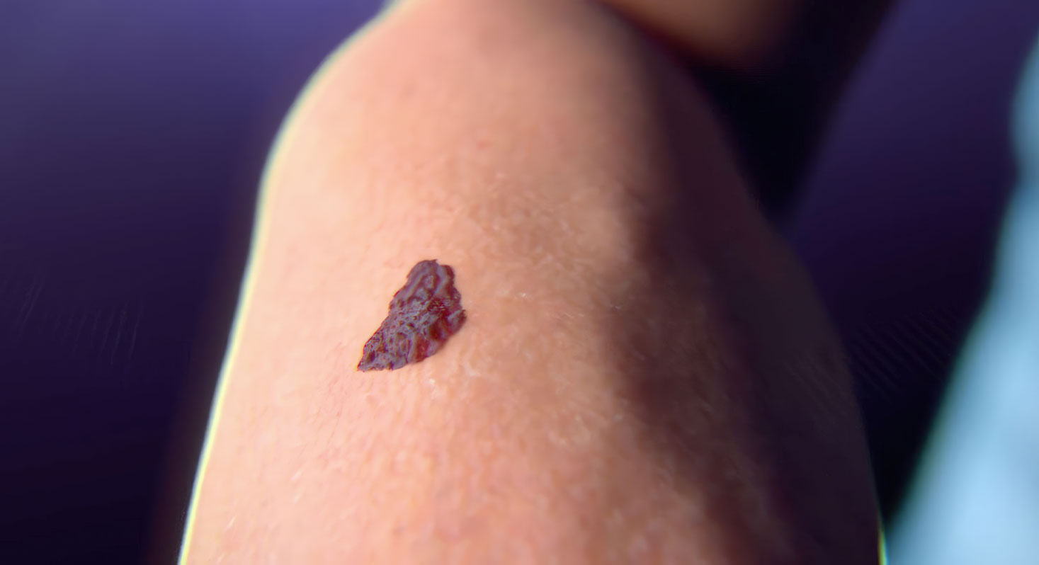 Medical illustration of NanoNeedle Biodegradable Microneedle Patch for skin cancer treatment. Animation by Ghost Productions showcasing antigenic peptide delivery system that elicits a systemic immune response. Visually compelling depiction of future cancer treatment.