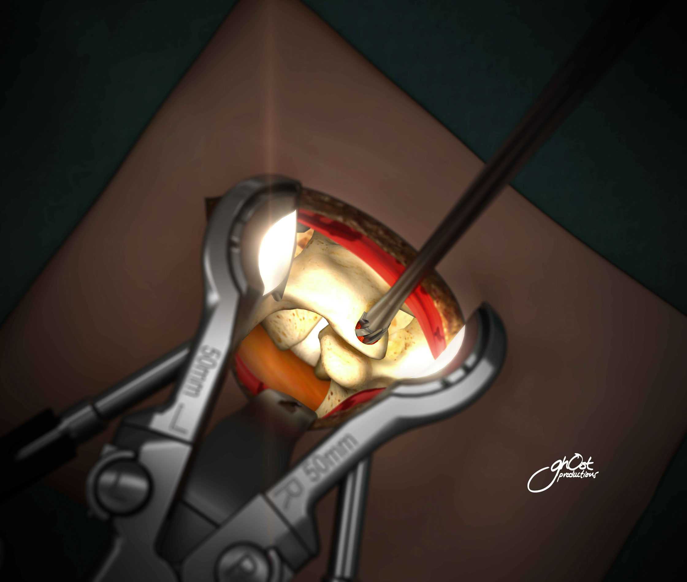 The DePuy Synthes Spine SPOTLIGHT PL Access System is a system for minimally invasive posterior-lateral fusion. It includes retractors with integrated fiber optic lighting and decortications instruments, designed to work with the VIPER 3D MIS Correction Set. This procedure is used to treat degenerative disc disease, spinal stenosis, scoliosis, and complex deformities. The SPOTLIGHT PL Access System is advanced and precise, making it a game-changer in spinal surgery.