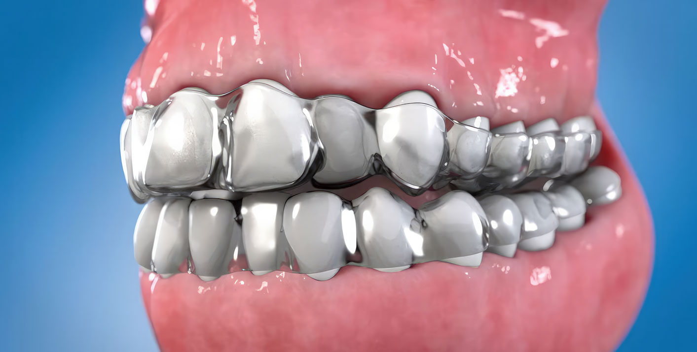 Medical animation showcasing ClearAligners by Patterson Dental, an alternative to braces. Provides a guide to the process from patient assessment to application. Valuable resource for patients and practitioners.