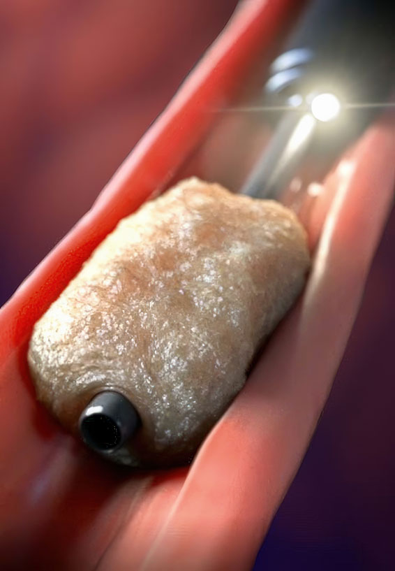 Animation showcasing the Piranha ER Sheath and Aspiration Catheter by Biomerics for treating esophageal food impaction. The Clinical Luminal Endoscopic Assessment of a Novel Suction (CLEANS) Technique is demonstrated, using the Piranha GI Aspiration Catheter to suction food away from the center of the impaction. This reduces the food bolus volume, allowing for spontaneous passage into the stomach. Revolutionary medical device.