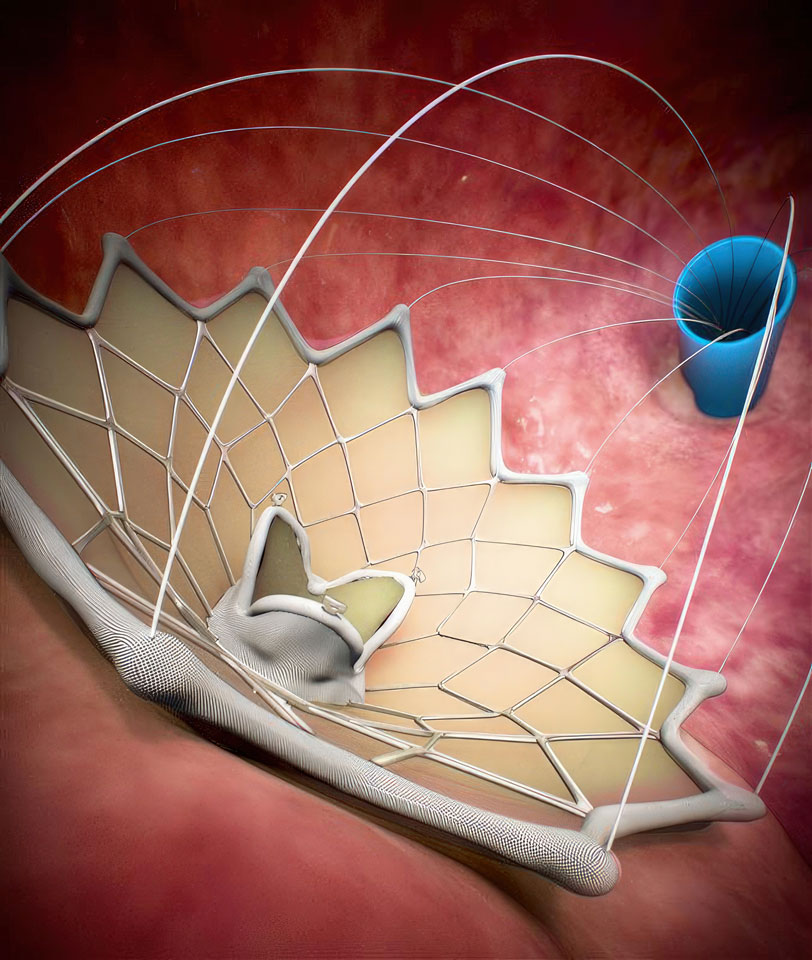 Medical illustration of the Caisson Transcatheter Mitral Valve Replacement procedure. The image shows a close-up view of the heart with a catheter being inserted through a vein in the leg and guided up to the heart. The malfunctioning mitral valve is replaced with an artificial valve through the catheter, without the need for open heart surgery. This cutting-edge, minimally invasive procedure offers a faster recovery time and reduced risk of complications for patients in need of mitral valve replacement surgery.