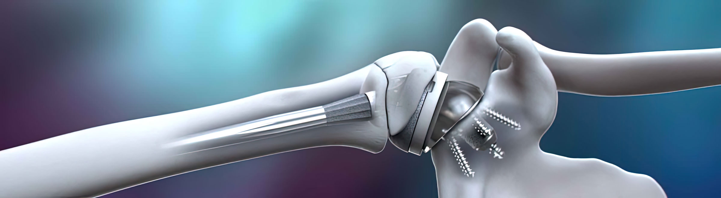 3D animation of Integra Life Sciences Shoulder Plates by Ghost Productions. Shows Modular Shoulder, Reverse Shoulder, and Proximal Humeral Plating Systems. Highlights innovative features and benefits. Improves patient outcomes.