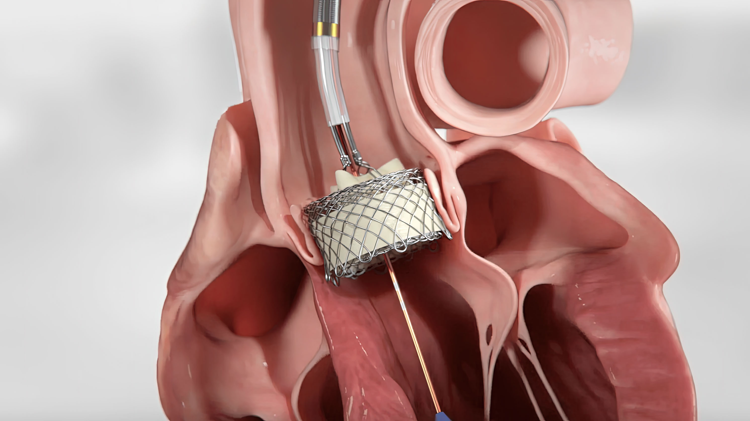 Detailed illustration of the human heart during a HLT TAVR procedure. Blood vessels and chambers are visible, highlighting the complexity of the cardiovascular system. Useful for medical professionals and students seeking to deepen their understanding.