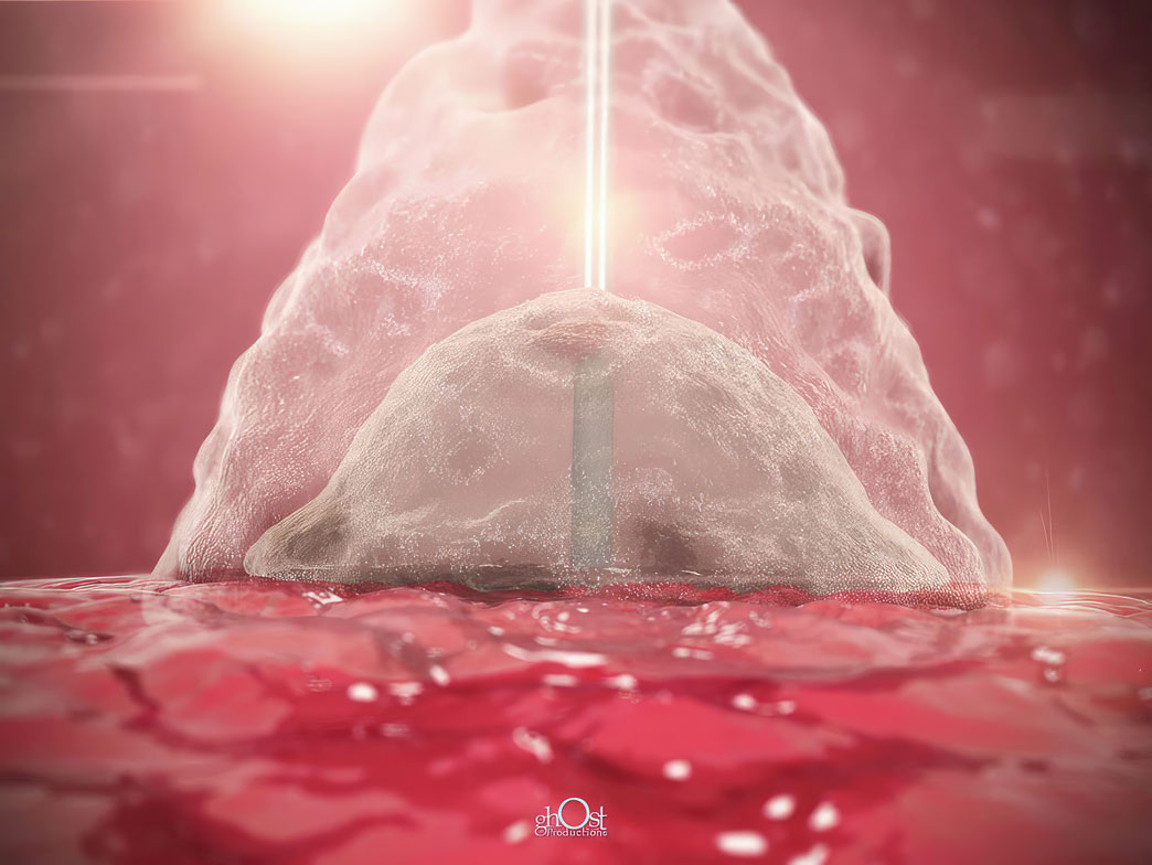 The Cardinal Health MynxAce Vascular Closure Device is a safe and effective solution for closing the femoral artery after diagnostic and interventional procedures. Its advanced technology and user-friendly design offer a superior alternative to traditional manual compression methods, minimizing the risk of complications and ensuring faster patient recovery. Ideal for healthcare professionals and patients seeking a stress-free procedure.