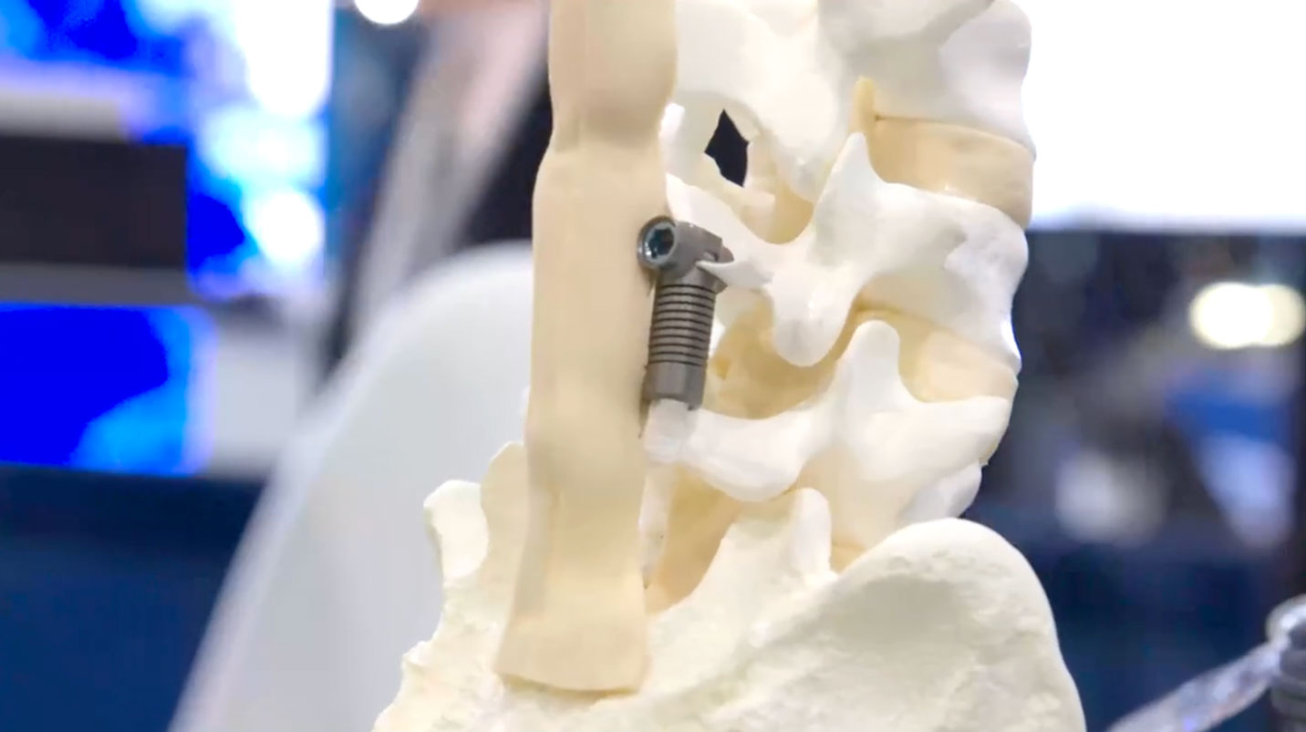 The Dynamic Sagittal Tether™ presents a potential alternative to spinal fusion, and Todd Alamin provided insights into the genesis of this innovative device and its potential benefits for patients.