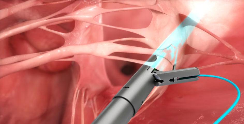 Heart Stitch NobleStitch EL Device | Cardiology Animation | Video