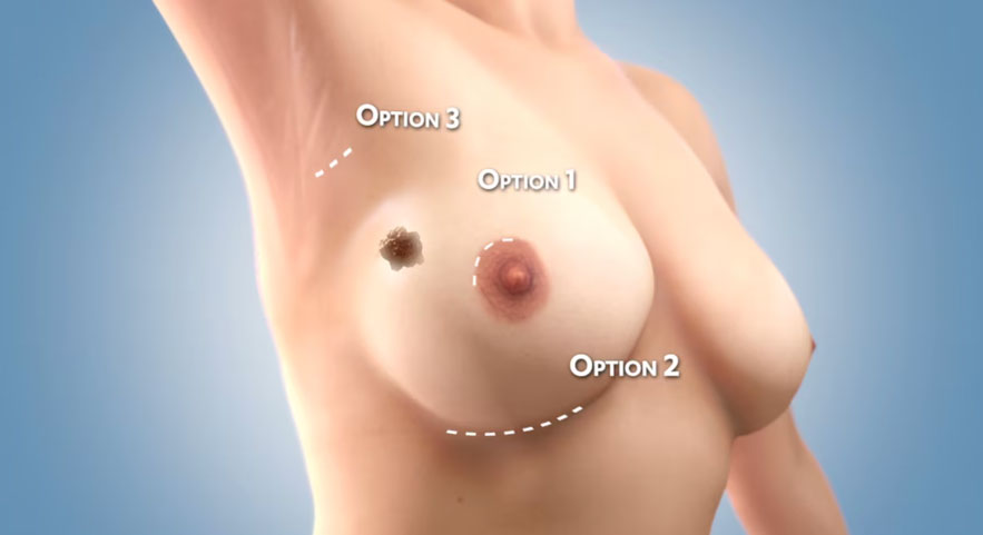Lumpectomy Procedure for Breast Cancer Animated 2016
