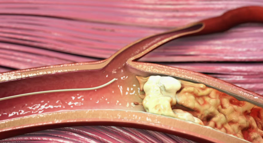 Medtronic Viance Crossing Catheter | 2016 Cardiovascular Animation
