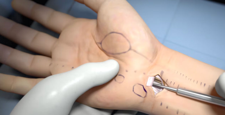 MicroAire SmartRelease Carpal Tunnel Release System | 2017  | Video