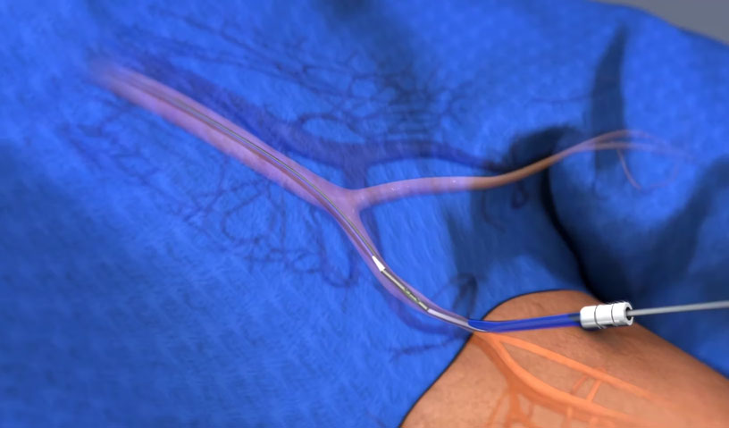 NobleStitch EL Heartstitch | Cardiology 2016 Animation