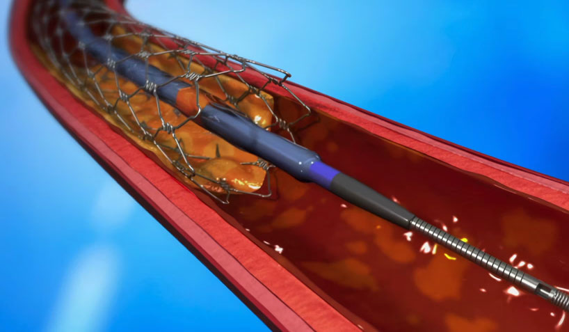 OptoWire One | Opsens Medical Animation 2015