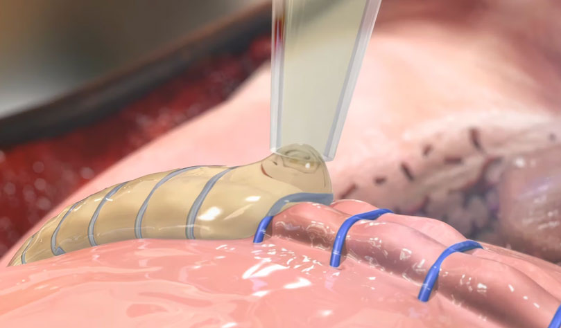 Preveleak Surgical Sealant | Baxter Advanced Surgery 2016 Animation