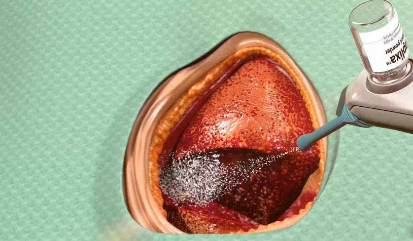 Raplixa™ Fibrin Sealant Powder for Surgical Haemostasis | 2016 Animation