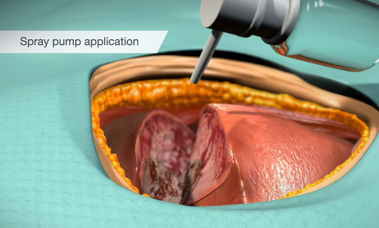 Recothrom Thrombin Topical to Aid Hemostasis | Baxter 2016 | Video