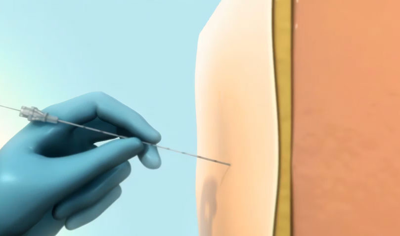 SPR Therapeutics: SPRINT PNS System 2014 Animation