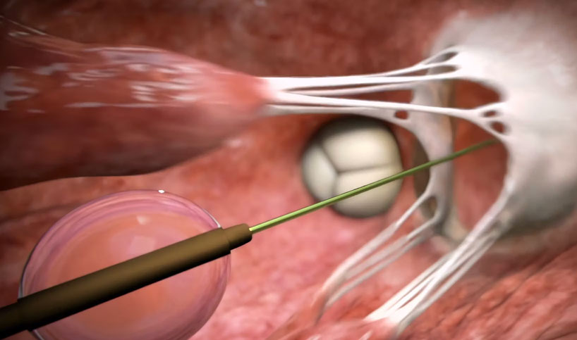  Tendyne™, Transcatheter Mitral Valve Replacement, TMVR, Ghost Medical Animation, Abbott, medical devices, diagnostics, pharmaceuticals, animation, MR (mitral regurgitation), less invasive, function, quality of life, Ghost Productions, medical animation studio, surgical VR simulation, accessibility, comprehension, precise, visuals, education, motivation, surgical device, patients, mechanism of action, pharmaceutical product, 3D anatomy, physiology.