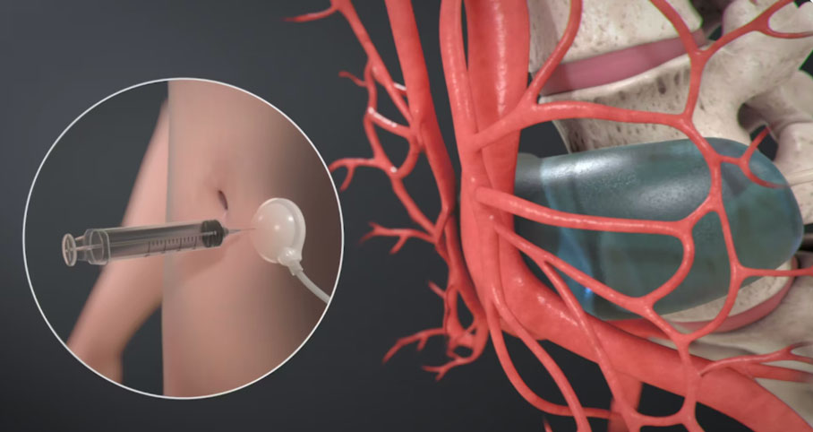 Tissue Expander Stimulated Lengthening of Arteries ( Tesla ) Procedure | Boston’s Children Hospital Animation