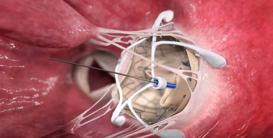 Caisson Interventional, medical device, percutaneous mitral valve replacement, investigational use, United States, PRELUDE Study, Ghost Medical Animation, visually compelling animations, Caisson implant, innovative components, severe mitral regurgitation, Ghost Productions, medical animation studio, surgical VR simulation, medicine accessibility, high-quality animations, virtual surgery simulations, medical industry, curious learner.