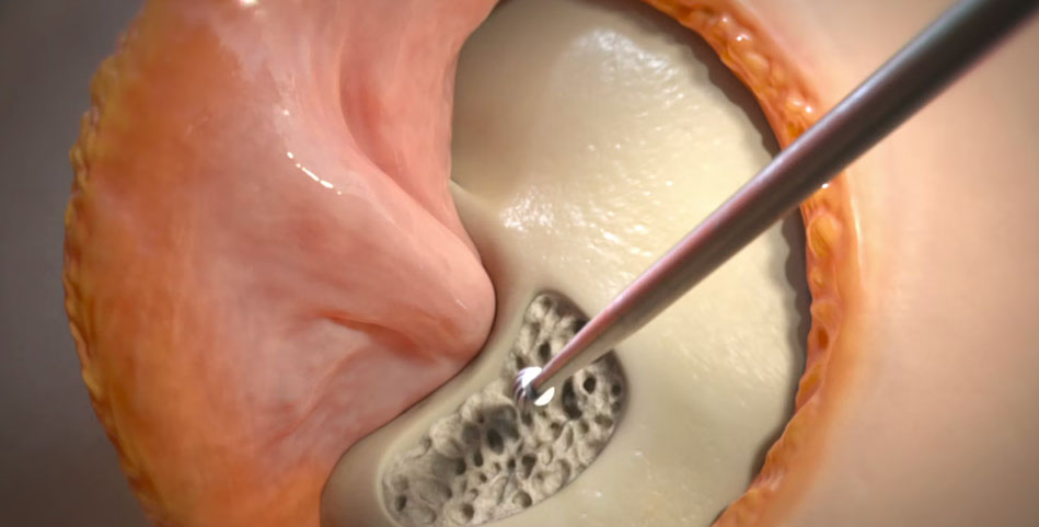 Transpetrosal Surgical Approach for Petroclival Meningioma Removal | Baylor Scott & White
