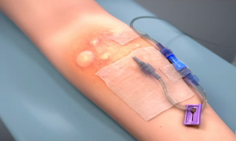 Types of IV Failure - IV Watch | Pharmaceutical Animation 2018 | Video