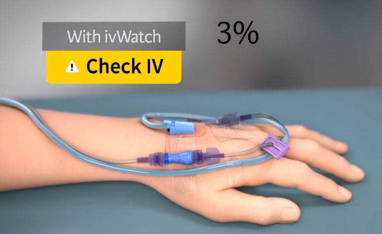 IV Watch - Early Detection of IV infiltration | Animation 2018