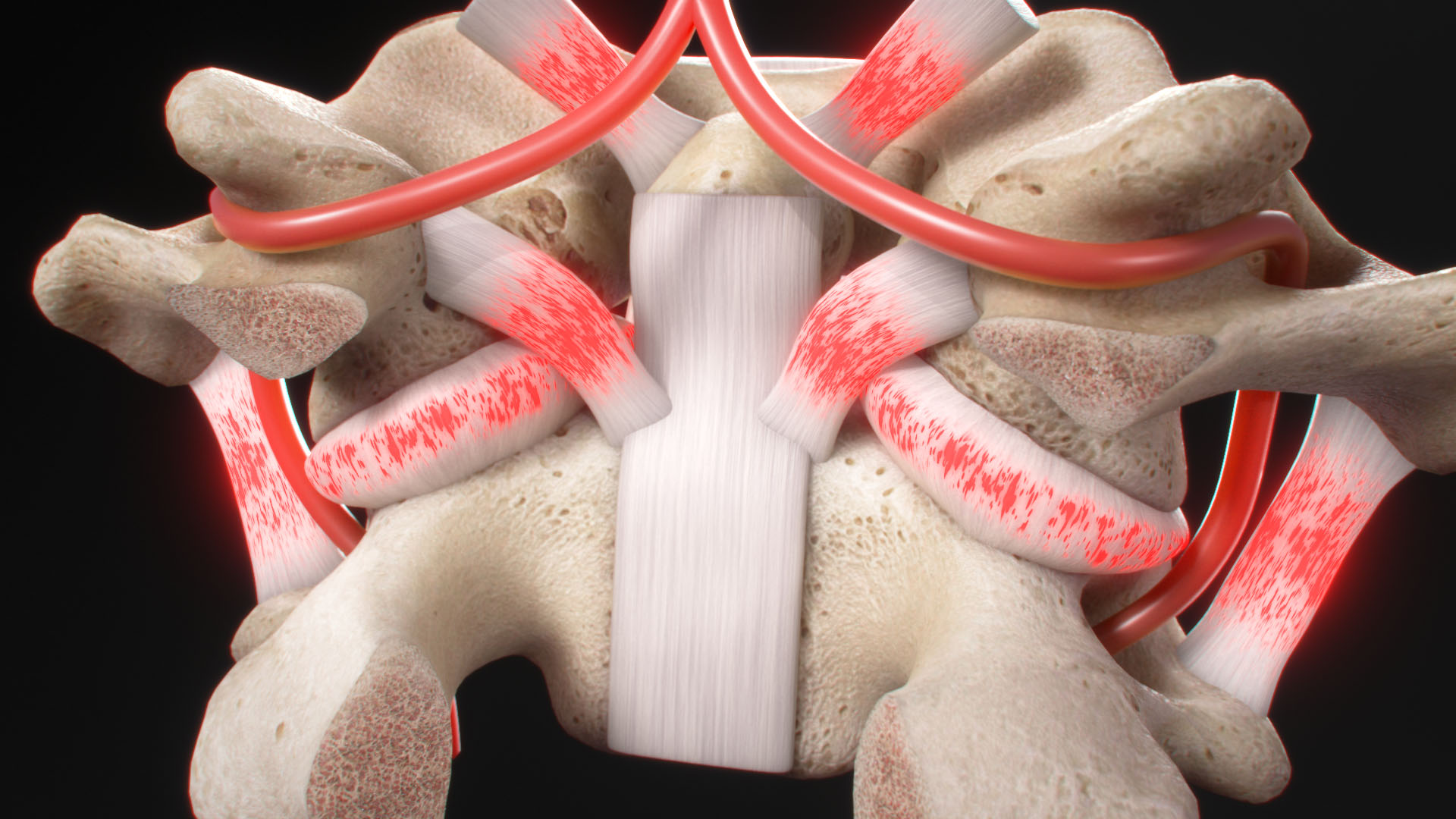 A Severe Angular Injury to the Spine. Damaged Spinal Support Ligaments