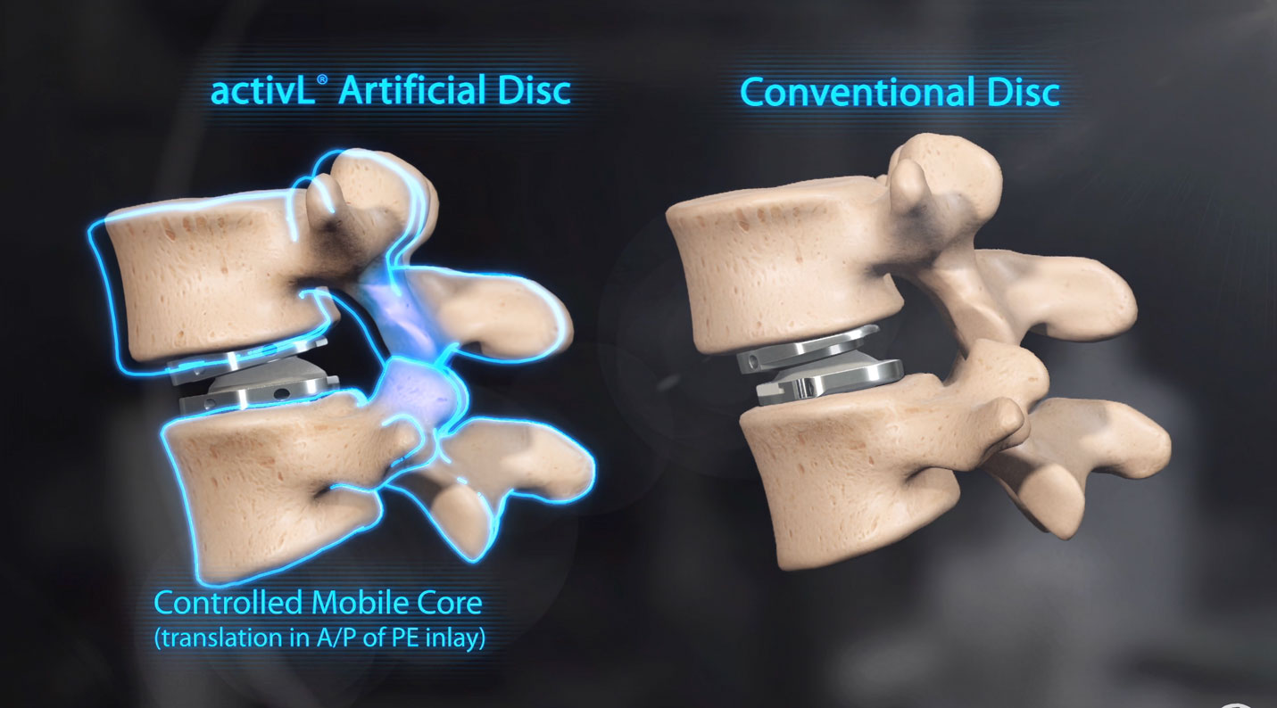 The activL Artificial Disc provides a controlled mobile core.