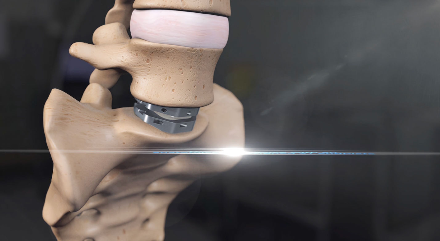 The activL Artificial Disc