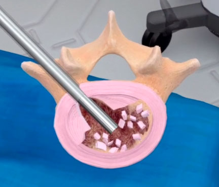 Suction: A step to implant Spineology's OptiMesh Device